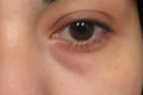 Ilustracija: podočnjaci